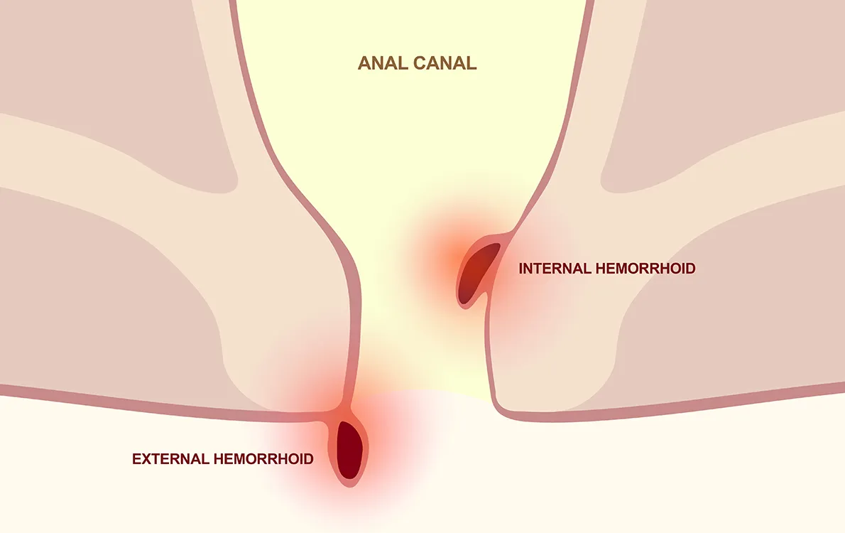 Hemorrhoids Treatment
