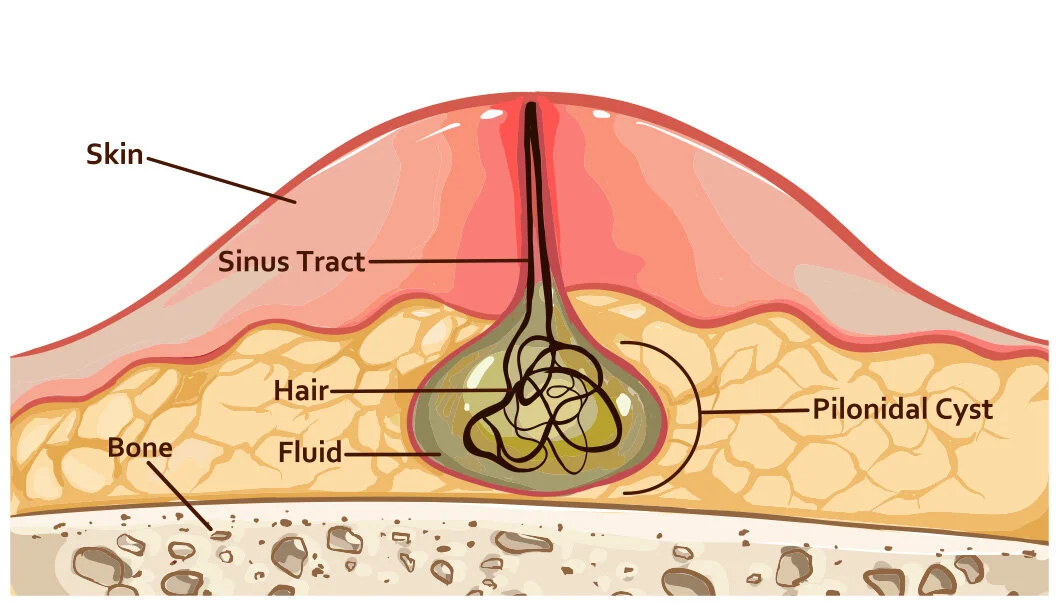 Laser Treatment for Pilonidal Sinus