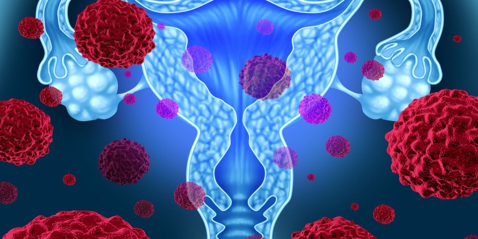 Uterine Fibroids Image 1